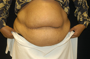 abdominoplasty1